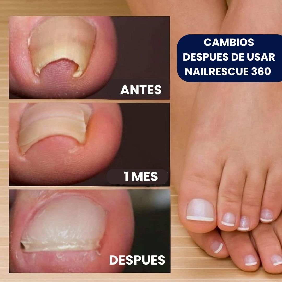 Nuevo NailRescue 360 Corrector de Uñas Encarnadas