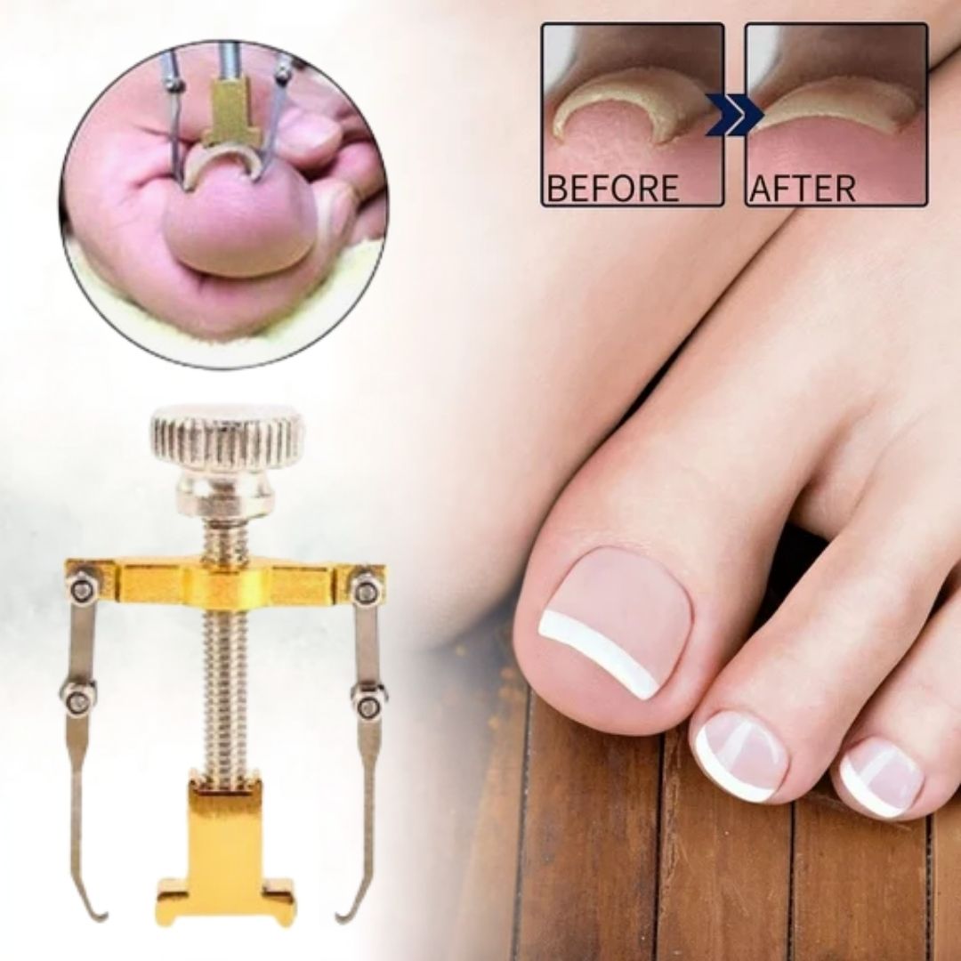 Nuevo NailRescue 360 Corrector de Uñas Encarnadas