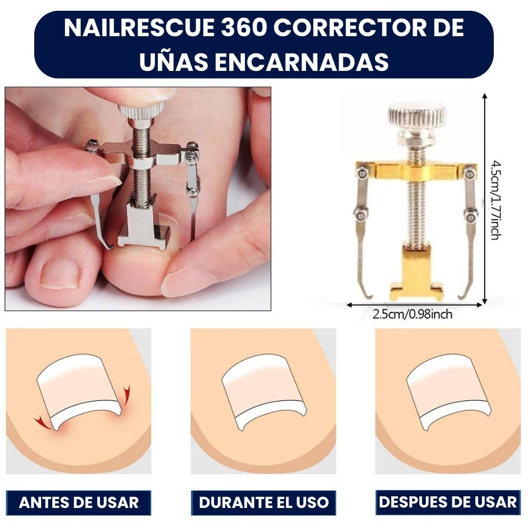 Nuevo NailRescue 360 Corrector de Uñas Encarnadas