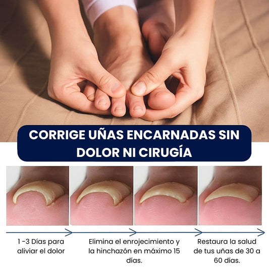 Nuevo NailRescue 360 Corrector de Uñas Encarnadas
